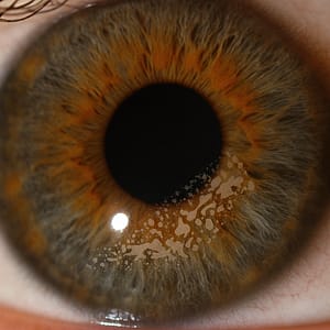 Invasion épithéliale sous le capot coréen post LASIK