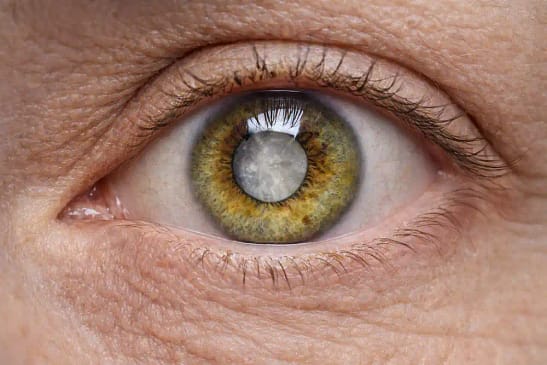 Gros plan d’un œil atteint de cataracte avec cristallin opacifié