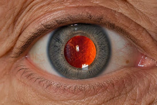 Œil avec vision troublée illustrant une cataracte secondaire