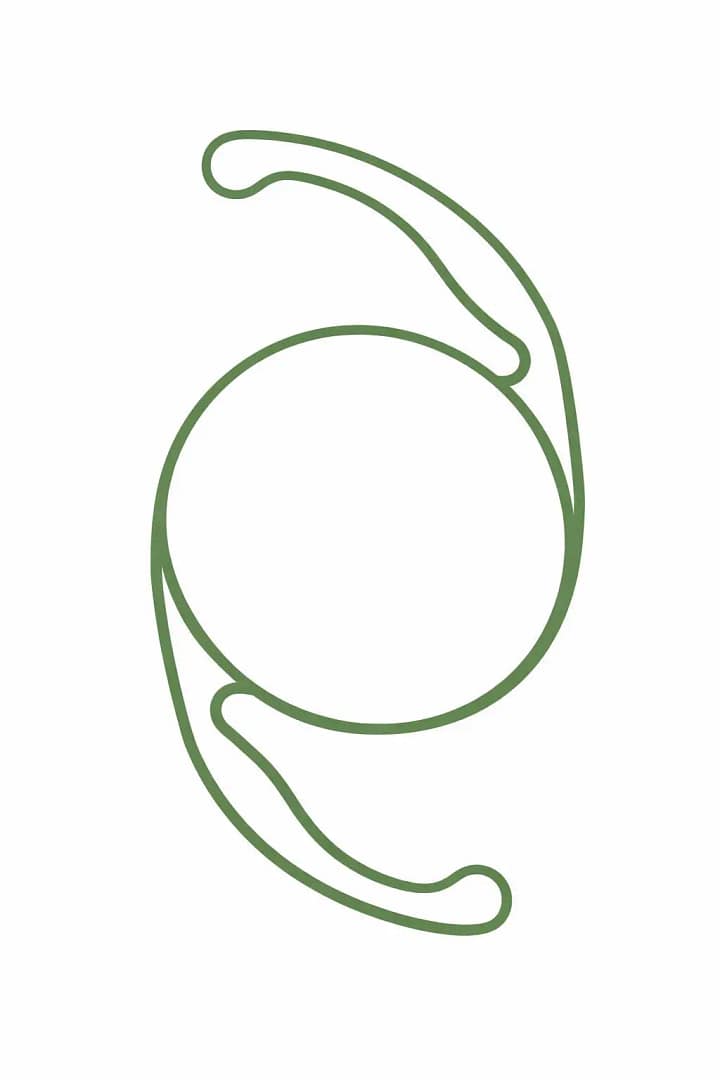 Implant monofocal utilisé en chirurgie de la cataracte pour corriger principalement la vision de loin