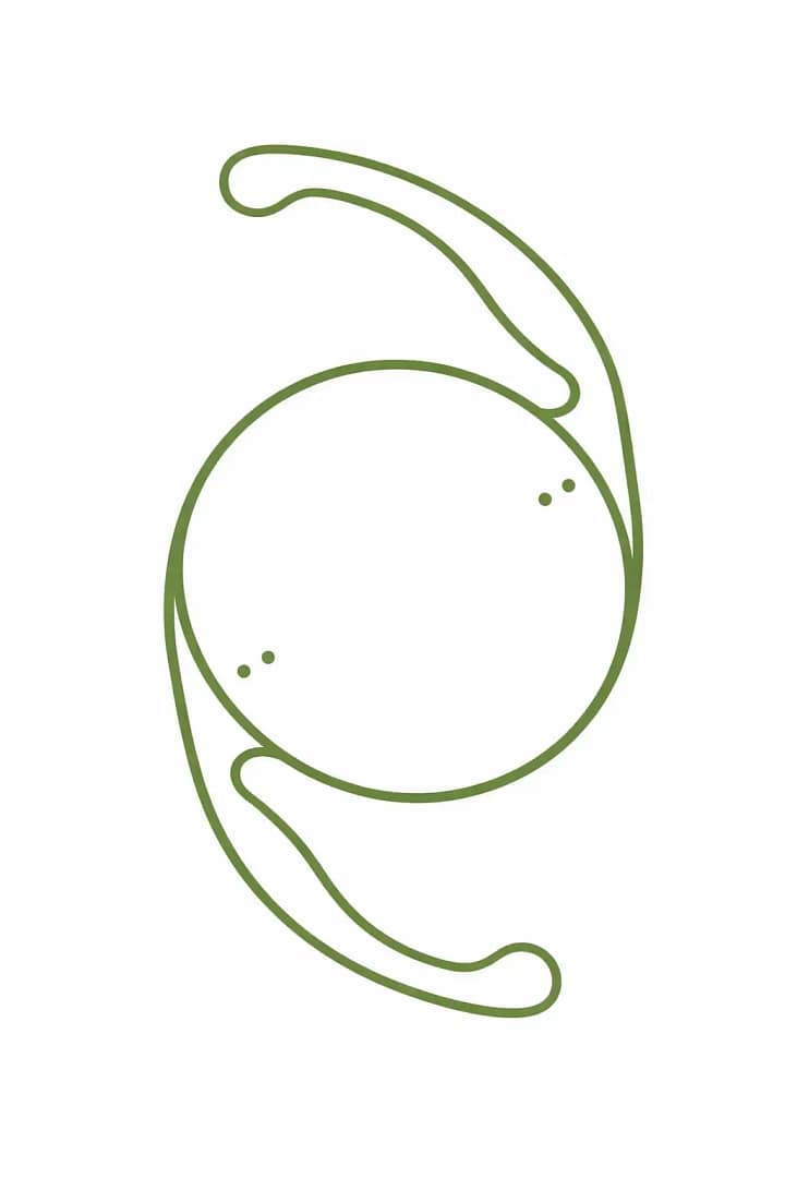 Implant torique utilisé en chirurgie de la cataracte pour corriger l’astigmatisme