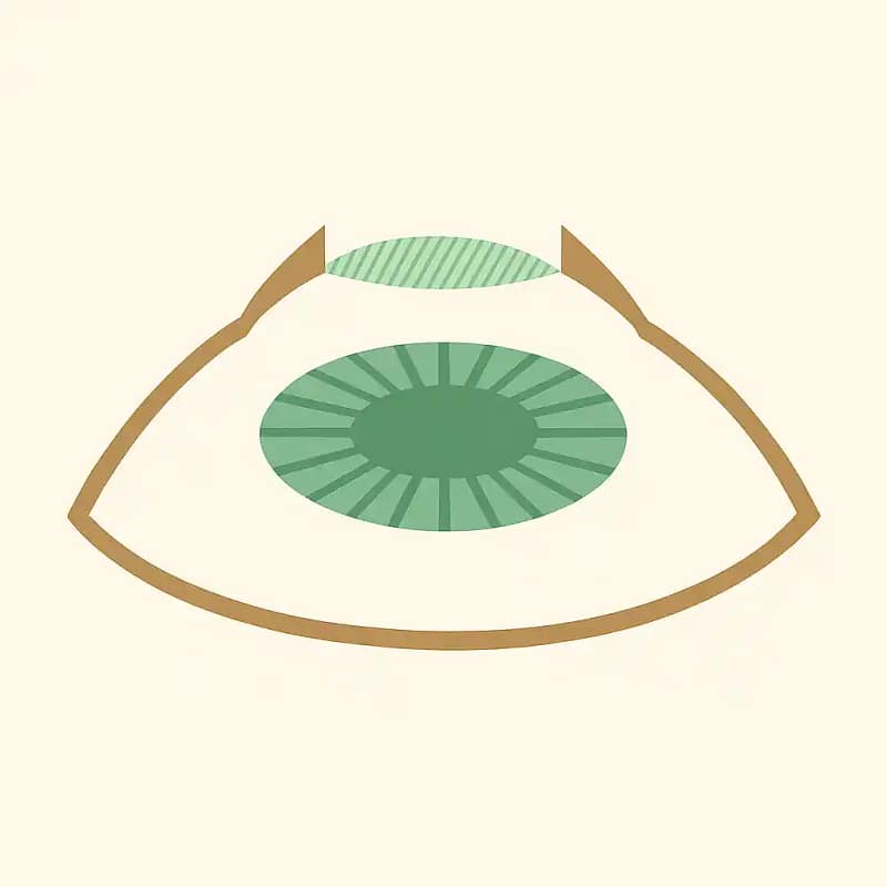 Illustration de la technique PKR – chirurgie laser de surface à Lyon par le Dr Aurélie Gimbert, ophtalmologue